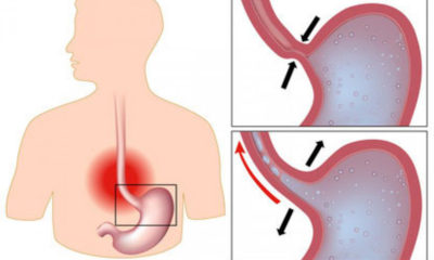 reflusso gastroesofageo