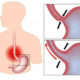 reflusso gastroesofageo